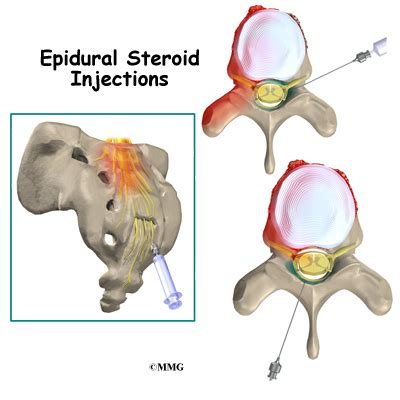 Epidural Steroid Injections - Midwest Bone and Joint Institute