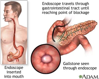 Endoscopic Retrograde Cholangiopancreatography (ERCP)