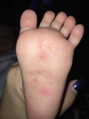 Rash on bottom of feet? UPDATE - March 2016 - BabyCenter Canada