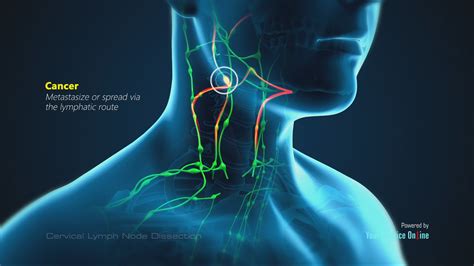 How To Drain A Lymph Node In The Neck - Best Drain Photos Primagem.Org