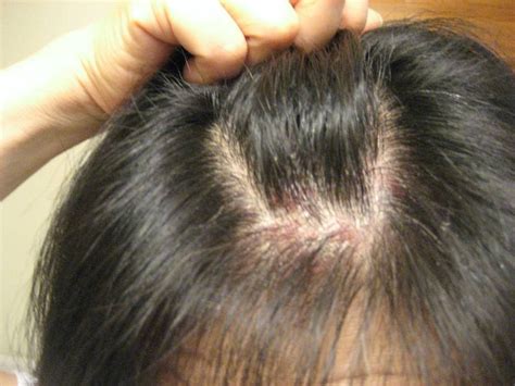 Understanding The Symptoms Of Skin & Scalp Psoriasis | Curly Chic