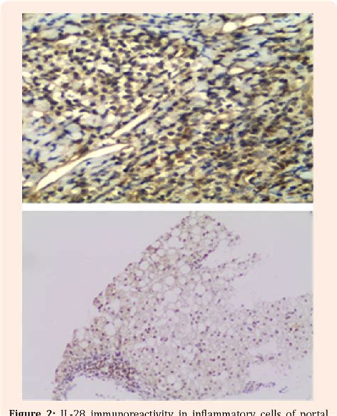 Figure 1 from Pathogenesis of HCV and Liver Fibrosis | Semantic Scholar