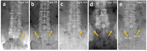 Surgeries | Free Full-Text | Prevalence of Lumbosacral Transition Vertebrae in Symptomatic ...