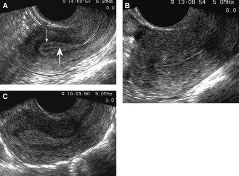 Swiss Cheese Endometrium Ultrasound at Shelia Smith blog