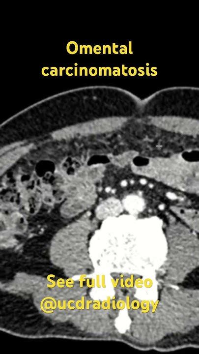 Omental carcinomatosis #radiologist #radiology #doctor #medicine #radiologyresident # - YouTube