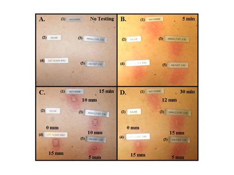 Allergy Wheal Size Chart