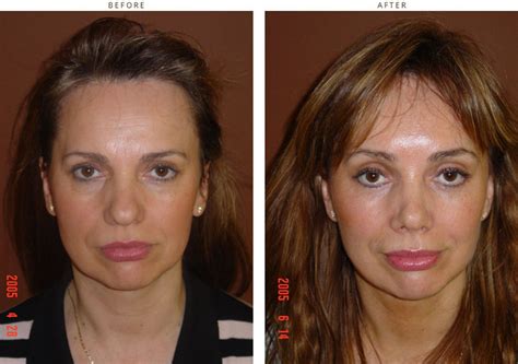 Mini Face Lift – Before and After Pictures * | Dr Turowski - Plastic ...