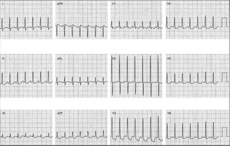 Atrial Tachycardia: Diagnosis - The Cardiology Advisor