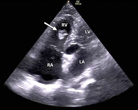 Right Heart Thrombus in Transit Diagnosed With Focused Cardiac ...