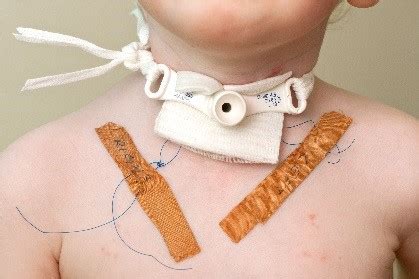 Care Fir or Tracheostomy and Feeding Tube at Home - Yoho Usprie