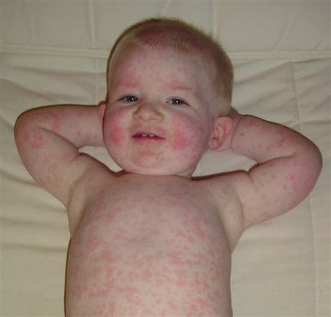 Fifth disease: causes, symptoms, diagnosis and treatment