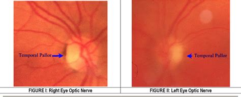 Figure I from Bilateral Internuclear Ophthalmoplegia as a Presenting Sign of Multiple Sclerosis ...