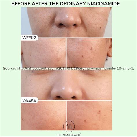 The Ordinary - Niacinamide 10% + Zinc 1%, Health & Beauty, Face & Skin Care on Carousell