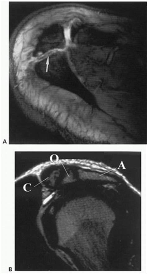 The Treatment of The Symptomatic Os Acromiale | Musculoskeletal Key