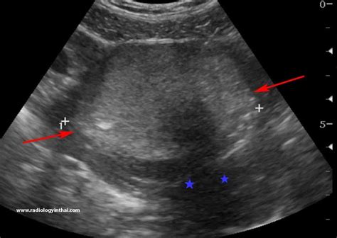 RiT radiology: Torsion of Ovarian Teratoma