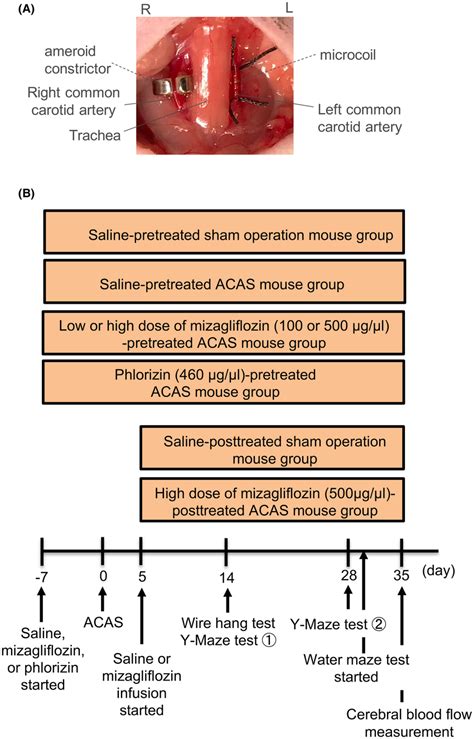 Panel A, Asymmetric common carotid artery surgery (ACAS) was performed... | Download Scientific ...