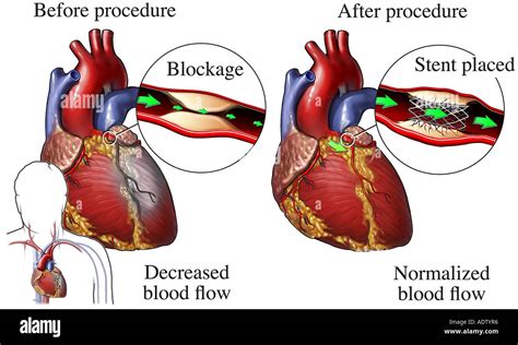 Repair blocked artery hi-res stock photography and images - Alamy