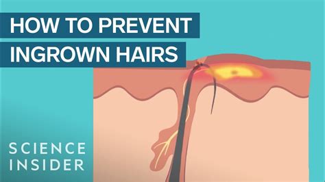 What Are Ingrown Hairs — And How To Treat Them - Science Metro