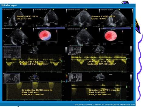 Dobutamine stress echo