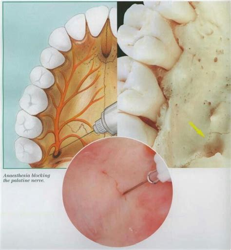 Greater palatin nerve block | Dental anatomy, Dental, Dental hygienist