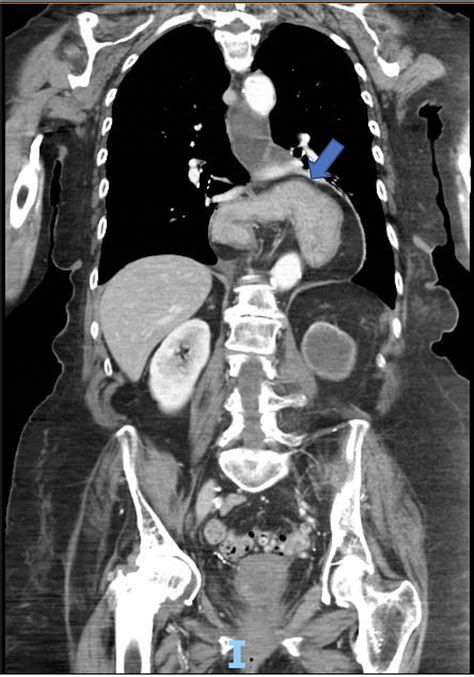 A Case of Intermittent Organo-Axial Gastric Volvulus | Cureus