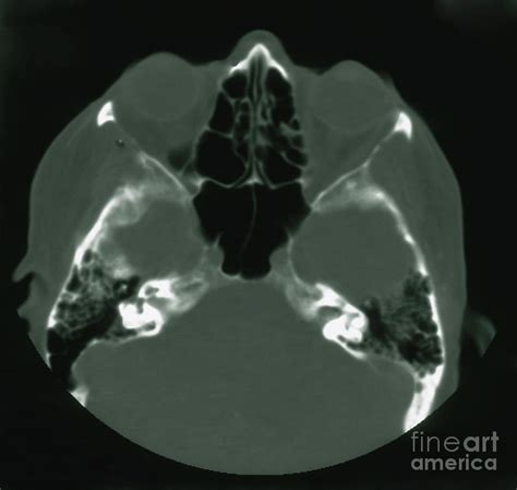 Normal Mri Of Sinuses Photograph by Science Source