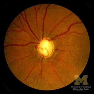 Pathologic Optic Disc Cupping : Ophthalmoscopic Abnormalities : The Eyes Have It