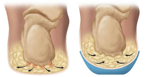 Heel Fat Pad Syndrome and Treatment | Heel That Pain