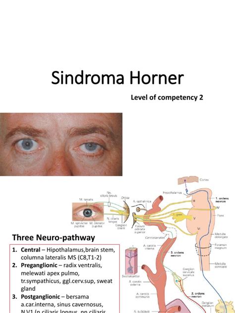 Horner Syndrome