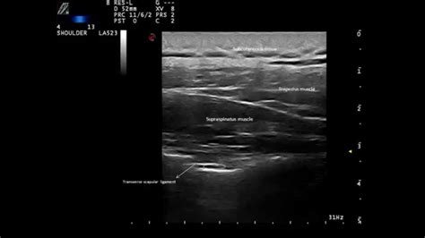 Ultrasound guided suprascapular nerve block, by Murat Karkucak MD - YouTube