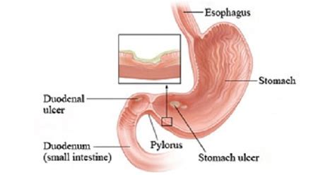 Peptic Ulcer (Gastric And Duodenal Ulcer) - New