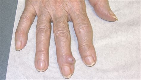 Derm Dx: Semi-translucent tumor on the finger - Clinical Advisor