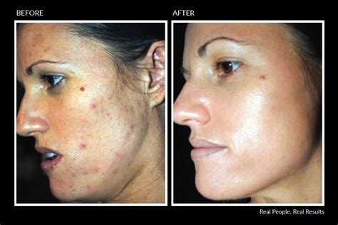 Perfect Derma Peel | North Bethesda, MD