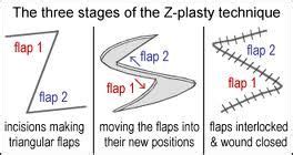 Z plasty stages | Plastic surgery, Surgery, Facial plastic surgery