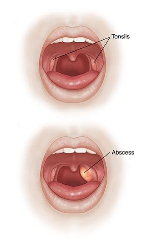 Peritonsillar Abscess | Saint Luke's Health System