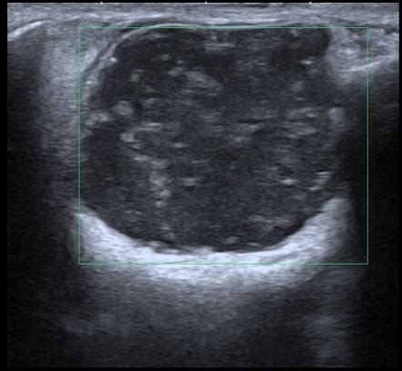 Subcutaneous Dermoid Cyst Ultrasound