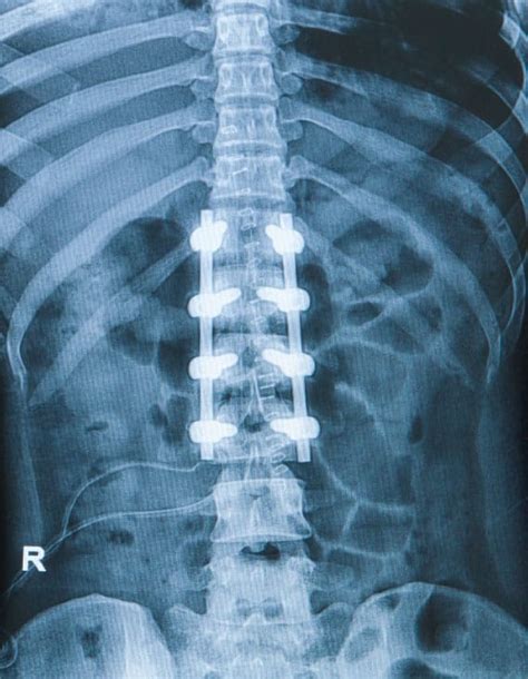 Surgery for Scoliosis | Monmouth Scoliosis Center