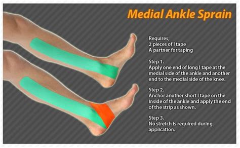 Kinesiology taping instructions for a medial ankle sprain #ktape #ares #ankle #sprain Ankle ...