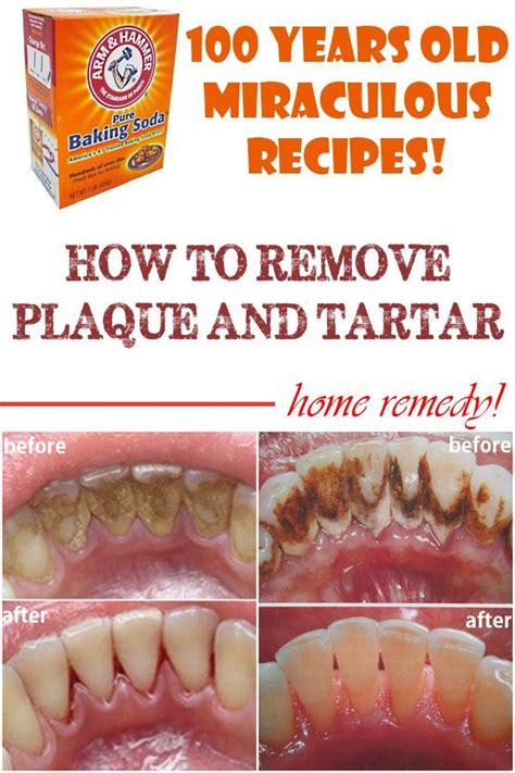 How to Remove Teeth Plaque At Home, Tips to Control Tartar - Healthy Beauty and Diet