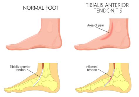 Anterior Tibial Tendonitis: Causes, Symptoms, and Treatment Options – GatsbyShoes