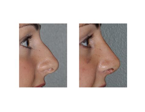 rhinoplasty recovery Archives