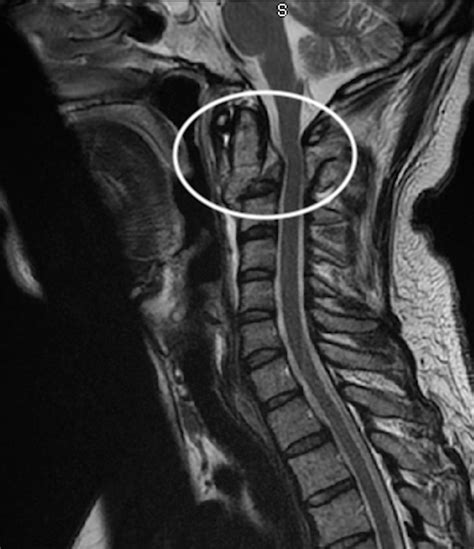 Cervical spine hangman fracture secondary to a gelastic seizure | BMJ ...