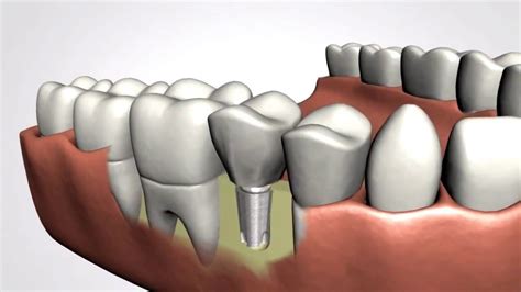 Boston Dental Implant Procedure - Step By Step - YouTube