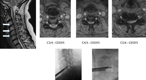 Severe central canal narrowing and multilevel cervical exit foraminal ...