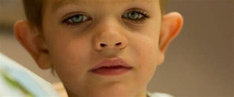 Fragile X Syndrome: Causes, Symptoms and Treatments - High Rated Gabru