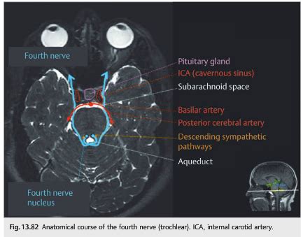 Questions of the Week: NOI13 Diplopia 6 – 4th Nerve Palsy — Neuro ...