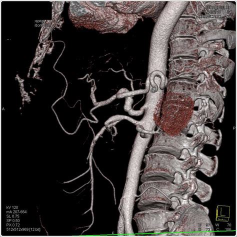 Aneurysm of the Celiac Artery - Vascular Case Studies - CTisus CT Scanning