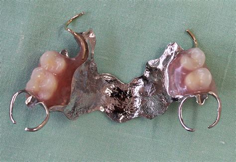 Partial Dentures (plates)