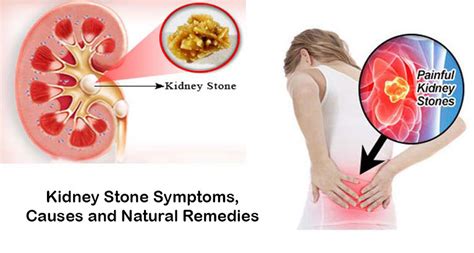 Kidney Stone Symptoms, Causes and Natural Remedies