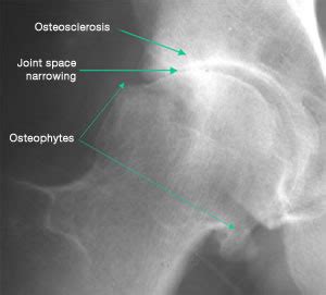 Osteophytes Hip